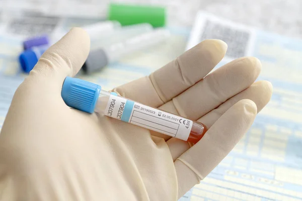 Blood sample test and empty tube blood for blood test screening with blank label for text in laboratory. blood test for coronavirus in the hospital. Patient's full name