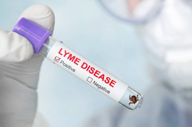 Bir doktorun ofisinde cam şişede Lyme hastalığı taşıyan tehlikeli bir taşıyıcı. Test tüpündeki Lyme hastalığı etiketi laboratuvar asistanının elinde. Kene ısırığından sonra hastaların teşhisi.