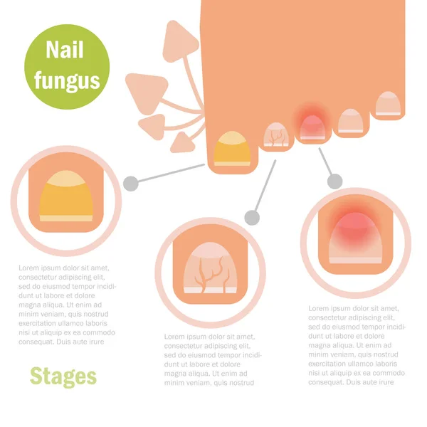 Nail fungus infection. — Stock Vector