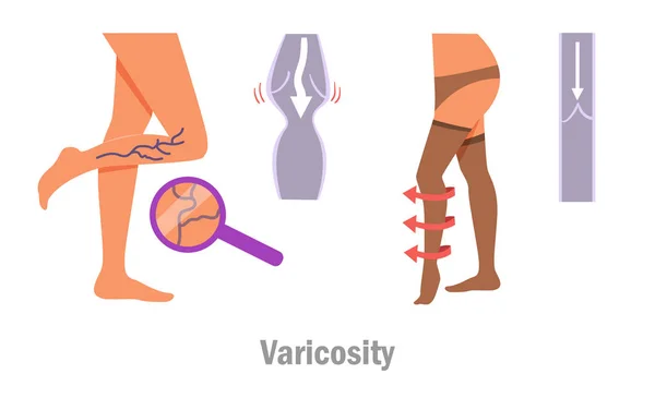 Varicosity. Piernas. Vector. Caricatura . — Vector de stock