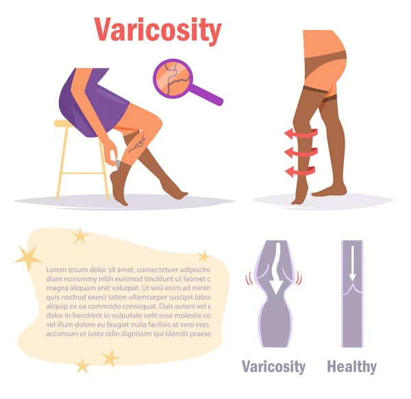 Varicosity. Piernas. Vector . — Vector de stock