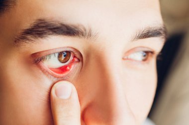 Mikrop kapmış arpa enfeksiyonu kapmış göz. Adam göz kapağını indiriyor ve Staphylococcus Aureus 'un sebep olduğu kirpik saç torbası iltihaplanma iltihabı gösteriyor. Meibomite. Sağlık hizmetleri