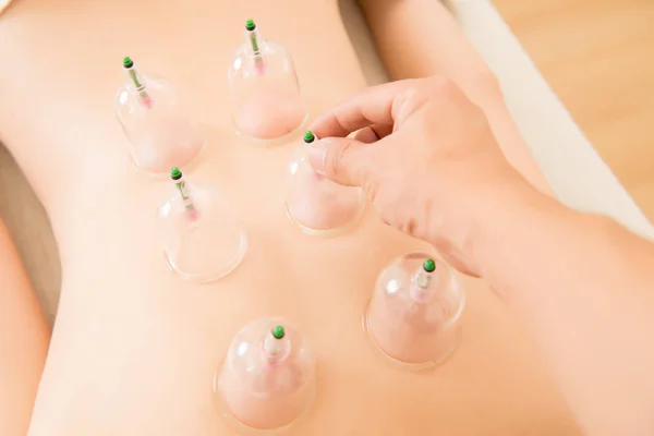 Acupuncture therapist removing a cupping — Stock Photo, Image