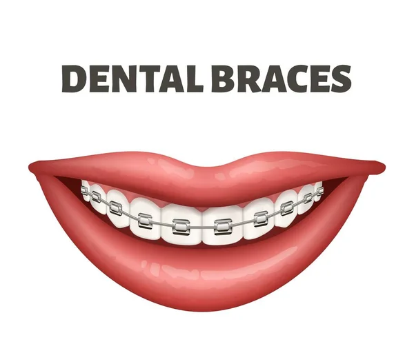 Ilustración vectorial de los aparatos dentales. Imagen que muestra la sonrisa humana y frenos en los dientes blancos . — Vector de stock