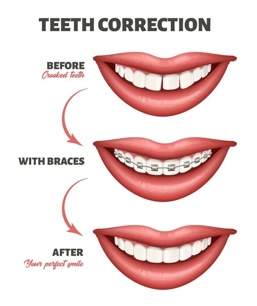 Cartel médico que muestra un proceso de corrección de dientes. Ilustración vectorial que representa la sonrisa humana, los dientes y los aparatos dentales . — Vector de stock