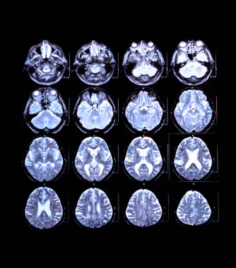 Bilgisayarlı Beyin Tomografisi - Cns Tıbbi İzleme - Xray, MR, Ct Tanısal Ekran Görüntüsü