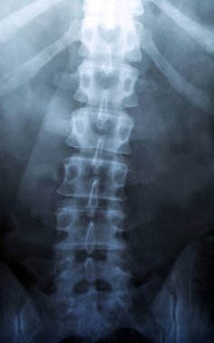 Omurga röntgeni - İnsan İskeleti Tıbbi Skolyozu veya Osteokondrosis Teşhis Testi - Xray, MR, CT Ekran Görüntüsü