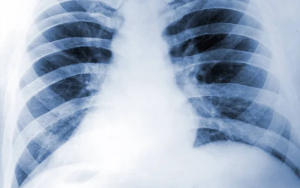Rayos Fluorograma Del Tórax Humano Prueba Diagnóstico Tuberculosis Médica Radiografía — Foto de Stock