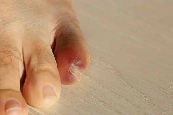 Dedo do pé com inflamação grave e hematomas — Fotografia de Stock