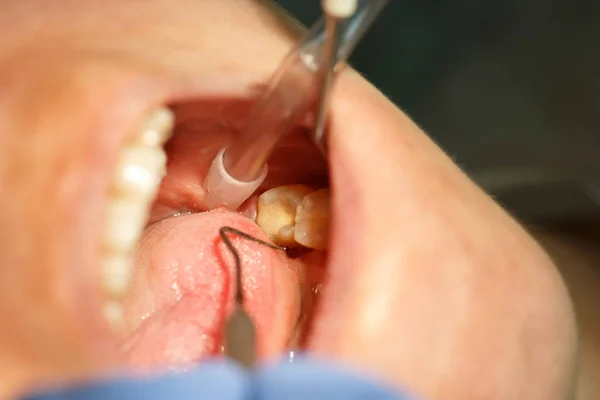 牙科病人得到她的牙齿和牙龈检查 — 图库照片
