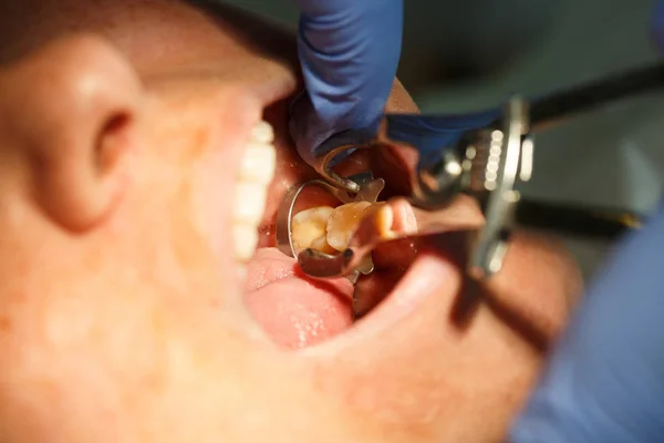 Tandheelkunde patiënt krijgt haar molaire tand vaste — Stockfoto