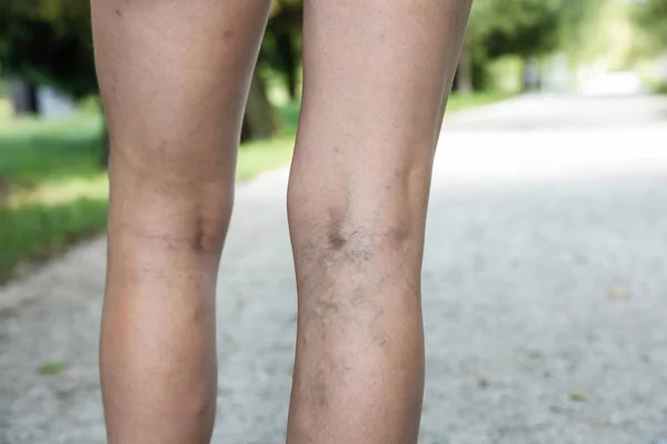 Varices douloureuses et veines d'araignée sur les jambes des femmes — Photo