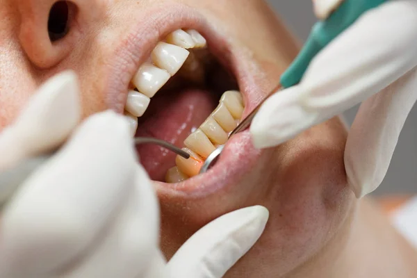 Laser dental usado em um paciente — Fotografia de Stock