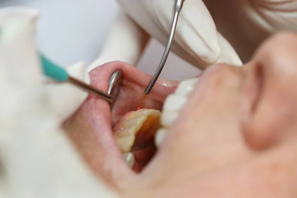 Tandheelkundige laser gebruikt op een patiënt — Stockfoto