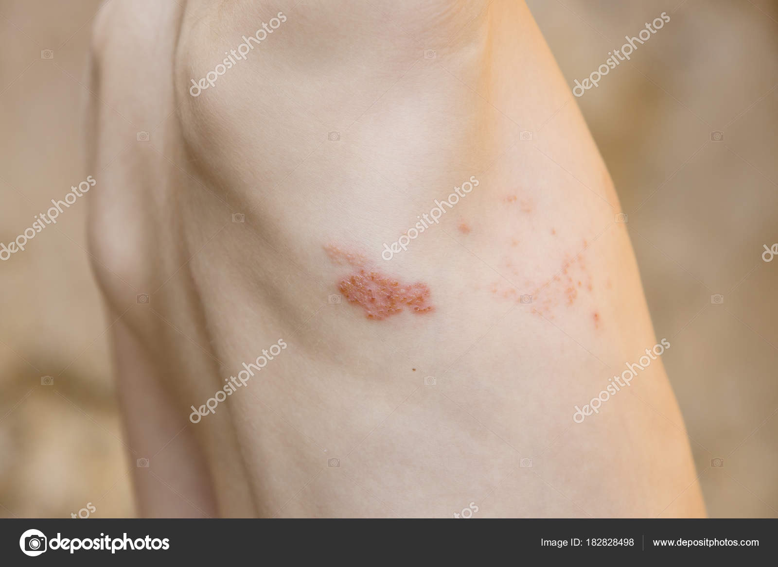 Herpes en los senos sintomas