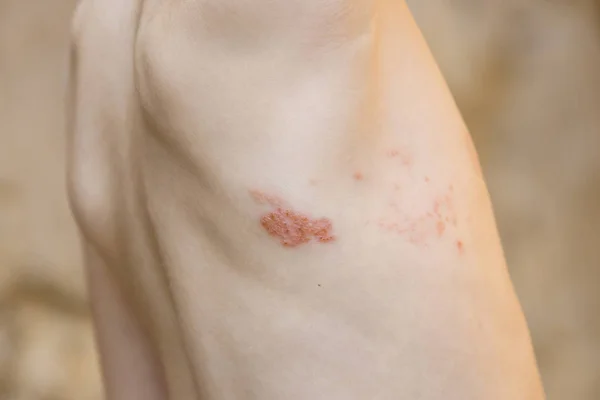 Sintoma de herpes zoster (telhas ) — Fotografia de Stock