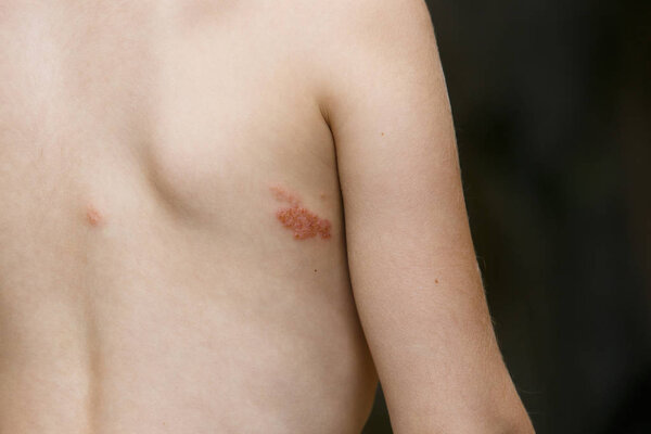 Симптом герпеса зостер (черепица)
)