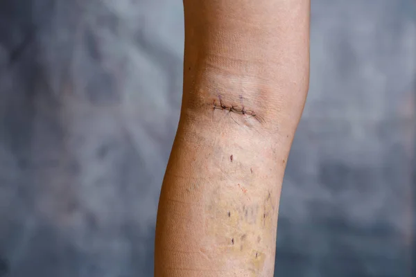 Womans leg after phlebectomy — Stock Photo, Image
