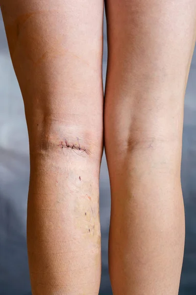 Womans leg after phlebectomy — Stock Photo, Image