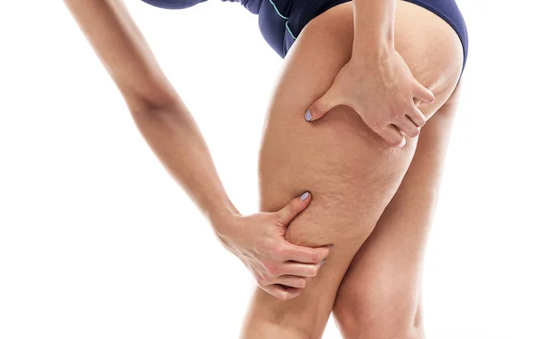 Cellulite sur les jambes féminines . — Photo