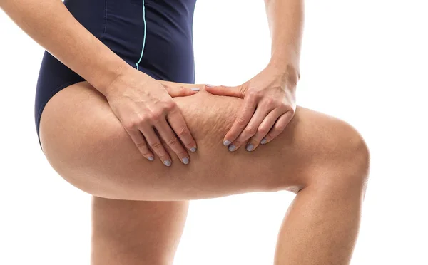 Cellulite sur les jambes féminines . — Photo