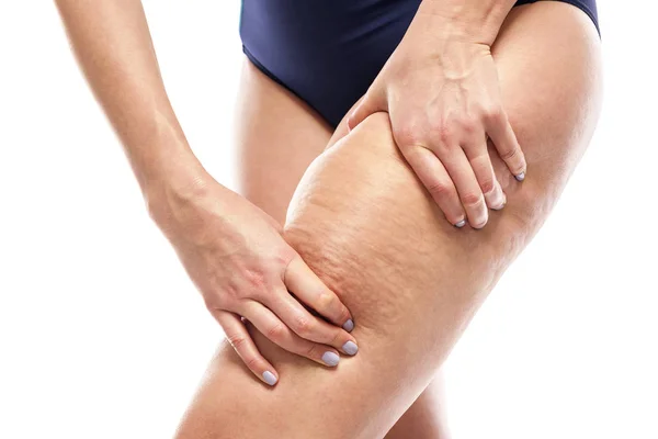 Cellulite sur les jambes féminines . — Photo