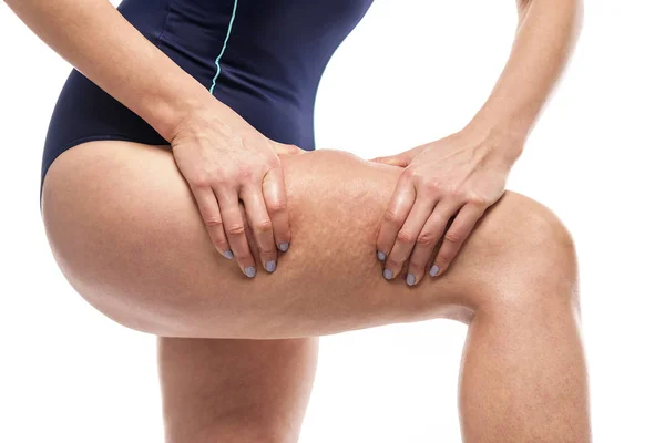 Cellulite sur les jambes féminines . — Photo