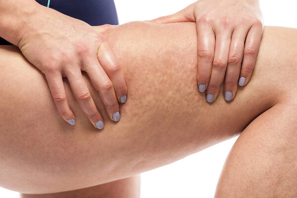 Cellulite on female legs.