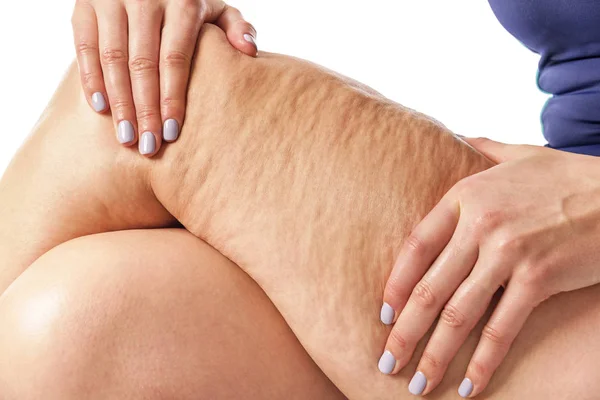 Cellulite e pelle libera . — Foto Stock