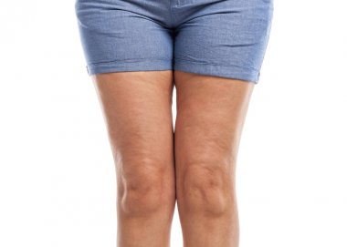 Fat and cellulite on the legs. clipart