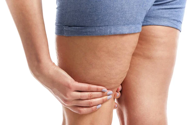 Gordura e celulite nas pernas . — Fotografia de Stock