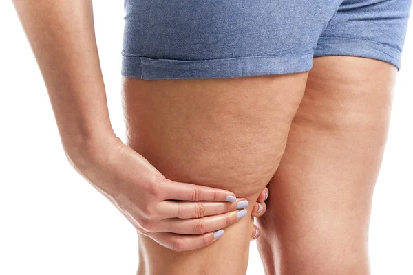 Grasa y celulitis en las piernas . — Foto de Stock