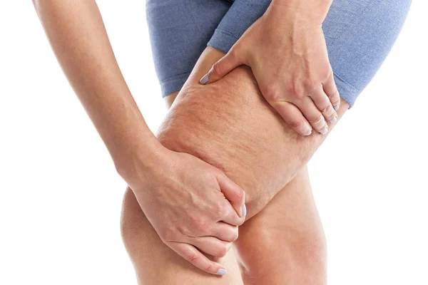 Graisse et cellulite sur les jambes . — Photo