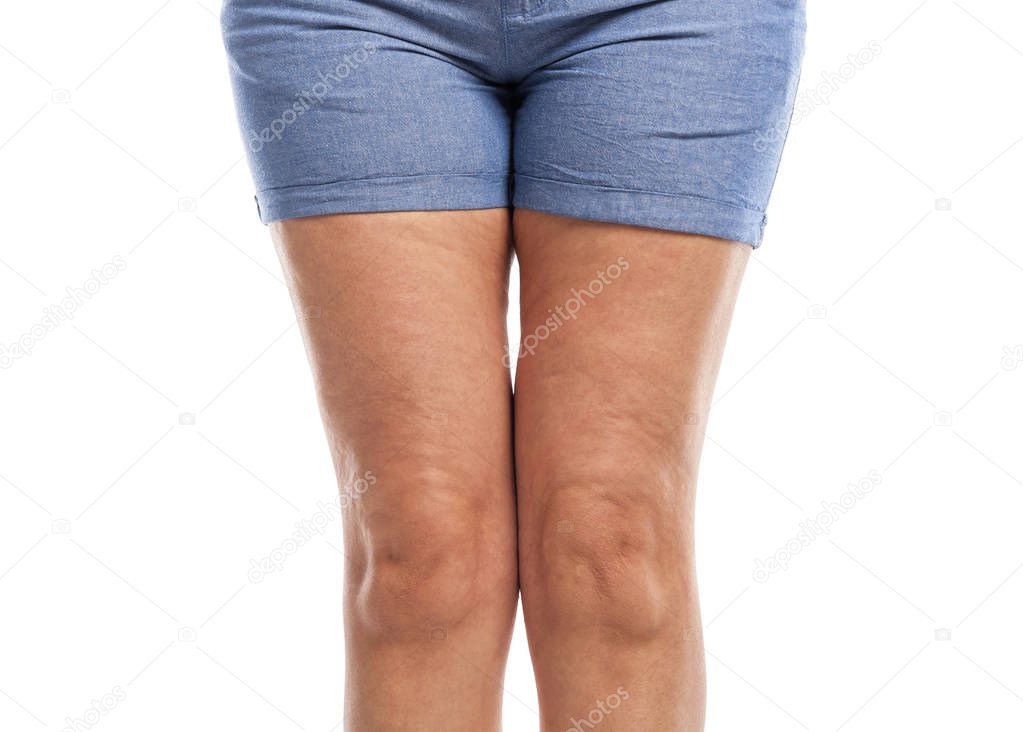 Fat and cellulite on the legs.