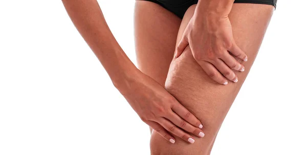 Cellulite sur les jambes féminines . — Photo