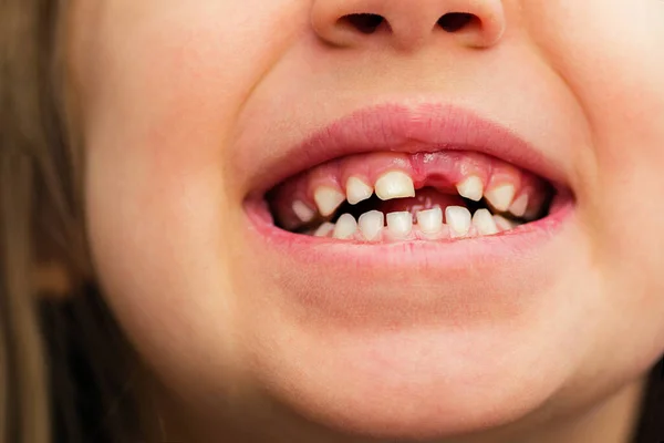 Зміна Зубів Перший Зуб Випав Дитини Дівчинки Ліцензійні Стокові Зображення