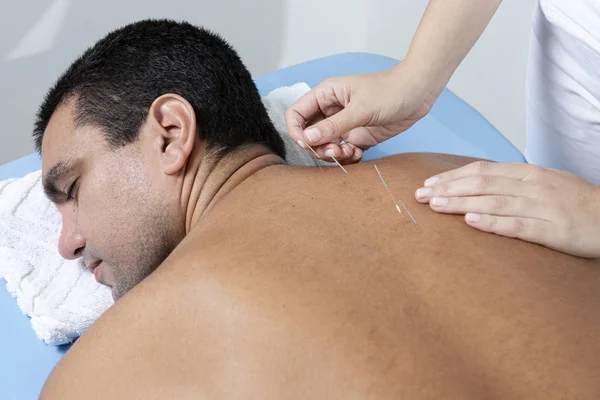 Therapist adjusting acupuncture needles on man back in aculpulture treatment.