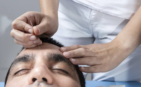 Detalj Terapeut Justera Akupunktur Nål Huvudet Man Akultur Behandling — Stockfoto