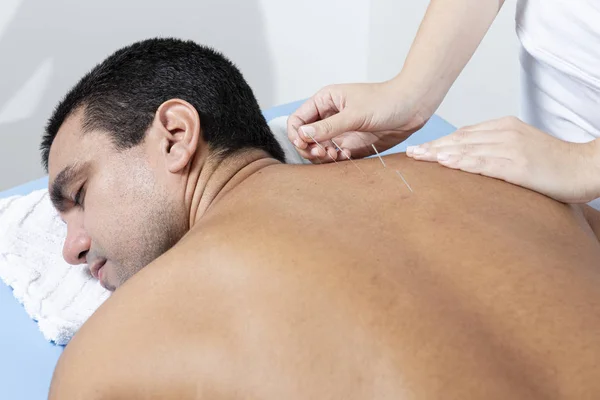 Therapist adjusting acupuncture needles on man back in aculpulture treatment.