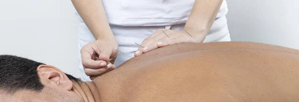 Detalhe Das Mãos Terapeuta Ajustando Agulhas Parte Trás Homem Tratamento — Fotografia de Stock