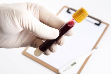 Nurse holding tube with blood for analysis. background with annotation worksheet and thermometer to check the patient.