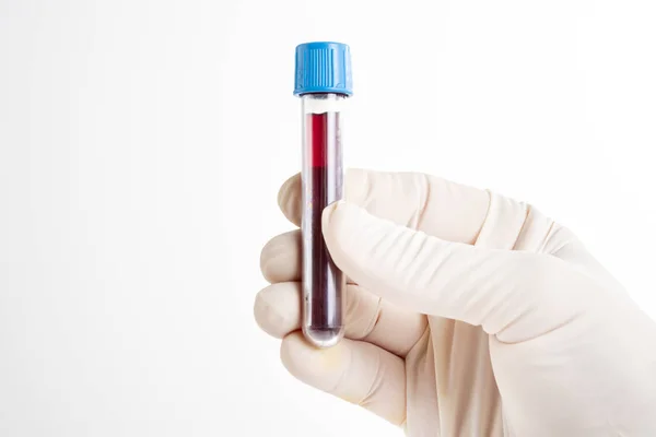 Кровью Полного Анализа Крови Выявления Заболевания — стоковое фото