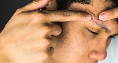 Akne, sıkmak erkekler acı sivilce