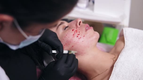 Procedimento anti-envelhecimento: cosmetologist profissional faz múltiplas injeções na pele de cara de mulheres durante a mesoterapia. Biorvitalização e levantamento facial — Vídeo de Stock