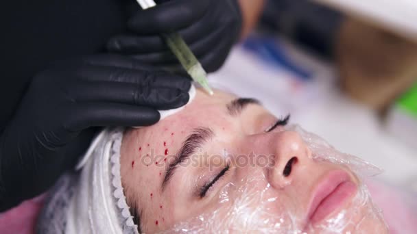 Jovem mulher está deitada no sofá, enquanto o comsetologista profissional em luvas está fazendo múltiplas injeções na testa das mulheres durante a mesoterapia. Biorvitalização e levantamento facial — Vídeo de Stock