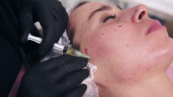 Професійний косметолог робить кілька ін'єкцій у жінок, які стикаються зі шкірою під час мезотерапії. Біоревіталізація та ліфтинг обличчя, нехірургічне лікування косметичної медицини — стокове відео