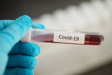 Covid-19 testi için kan örneği içeren test tüpü, Wuhan, Çin 'de bulunan yeni Coronavirus 2019..