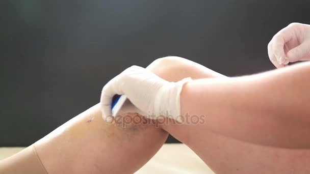 Нога после операции на варикозном расширении вен 2 — стоковое видео