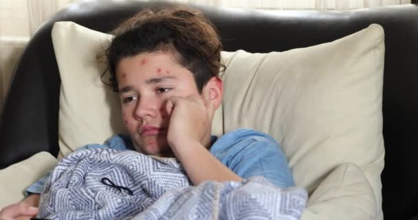 Portrét Unaveného Mladého Chlapce Trpícího Neštovicemi Vyrážka Poškrábání Obličeji Ležení — Stock video