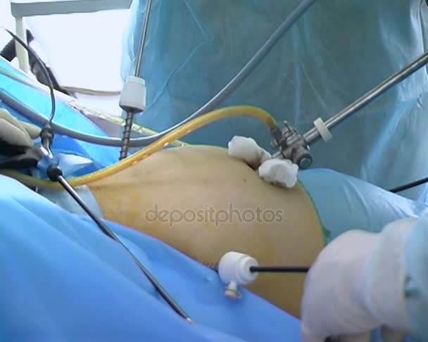 Operação com equipamento endoscópico. Mãos da equipe de cirurgiões durante a operação abdominal laparoscópica . — Vídeo de Stock